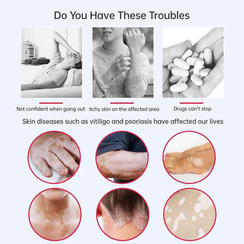 311Nm Ultraviolet Phototherapy Instrument Use UVB Philips Lamp UV for Vitiligo Psoriasis White Spots Skin Disease - Rejuvenate & Heal, Red Light Therapy, Health & Beauty